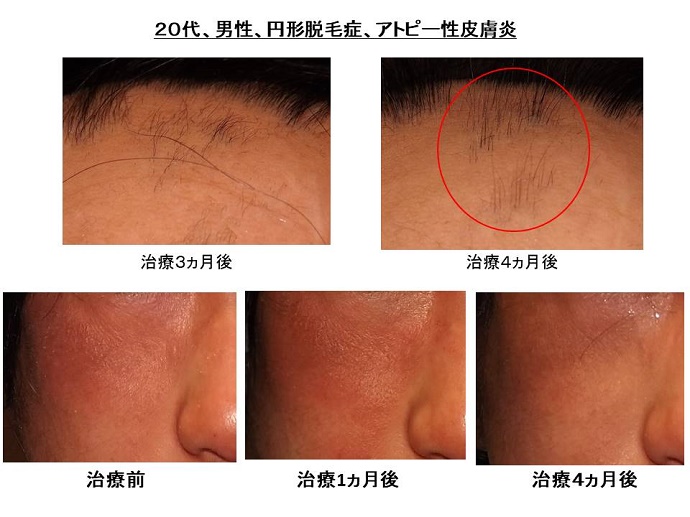 円形脱毛症　病院""